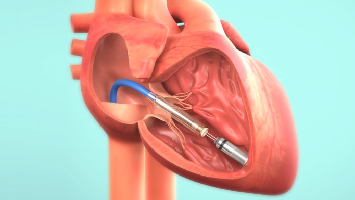 Micra impiantato nel cuore