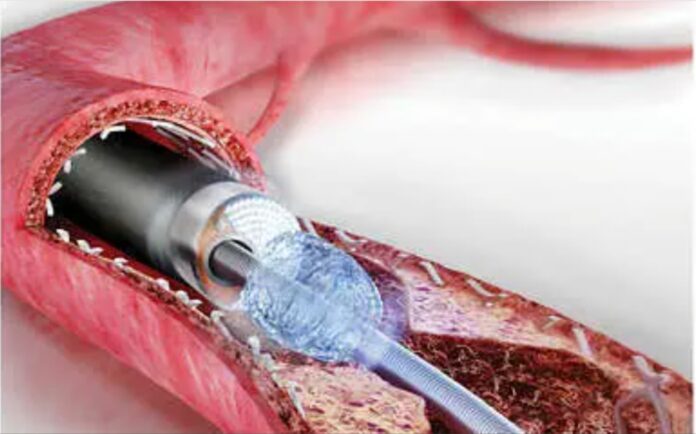FATEBENEFRATELLI CARDIOLOGIA IMMAGINE LASER