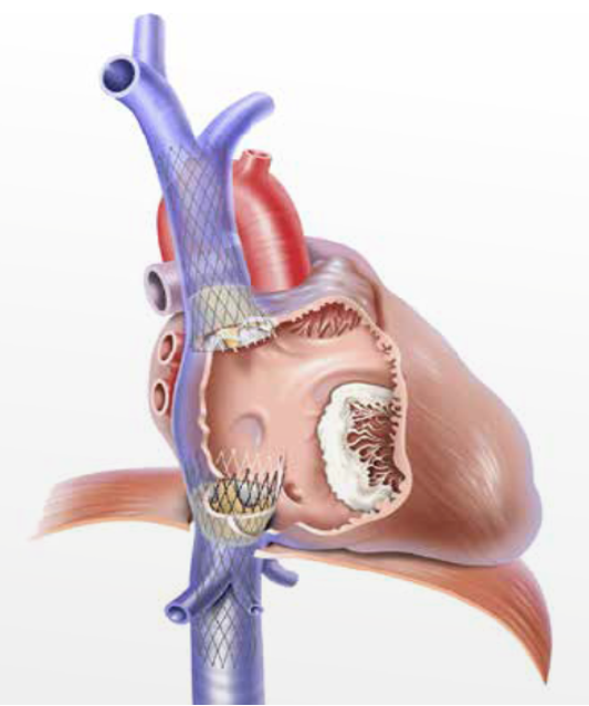 Fatebenefratelli Valvola cardiaca